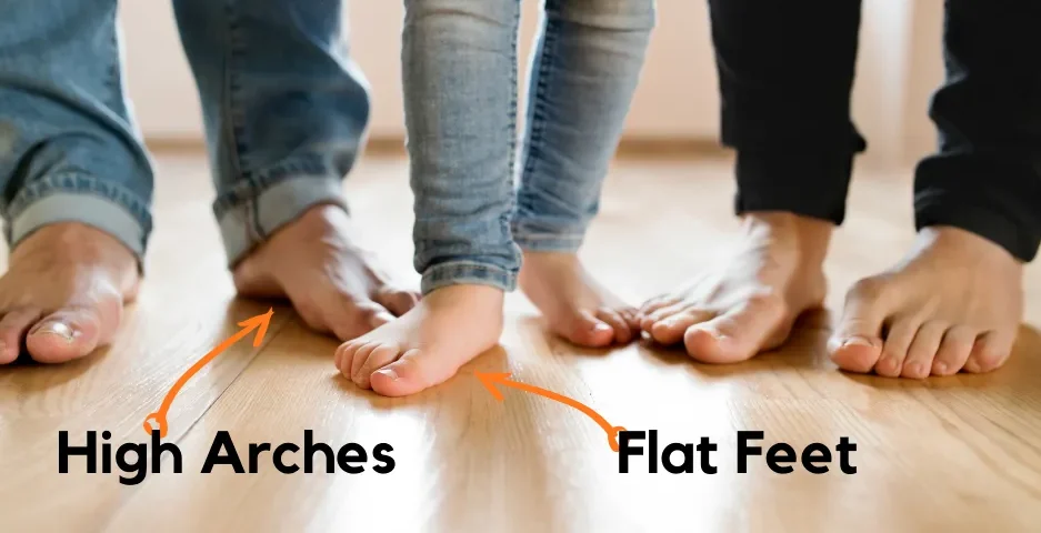 قوس زیاد کف پا